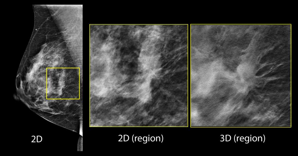 Digital tomosynthesis breast